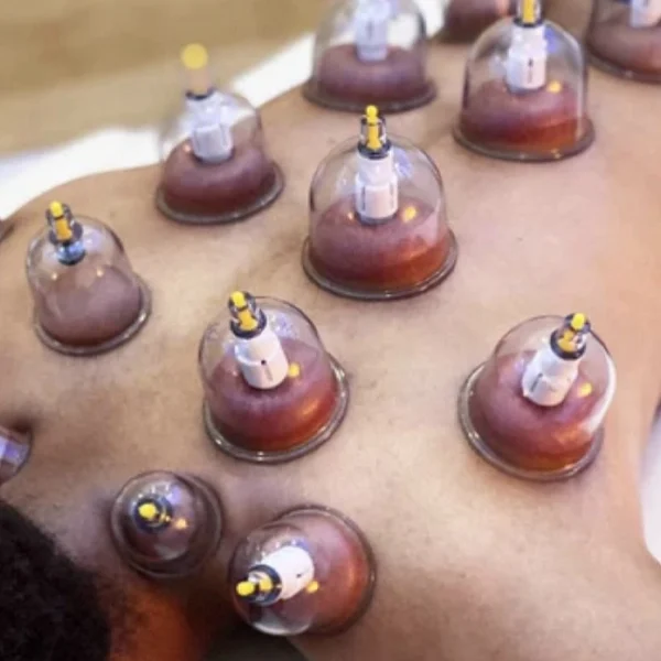 38. Cupping Therapy